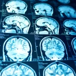 Ce influență are grupa de sânge asupra riscului de AVC la persoanele sub 60 de ani