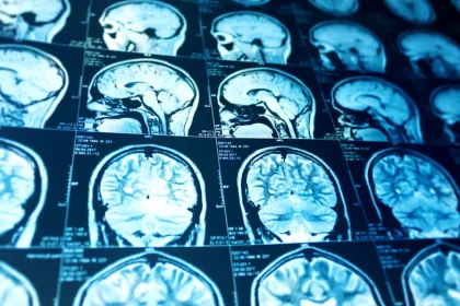 Ce influență are grupa de sânge asupra riscului de AVC la persoanele sub 60 de ani