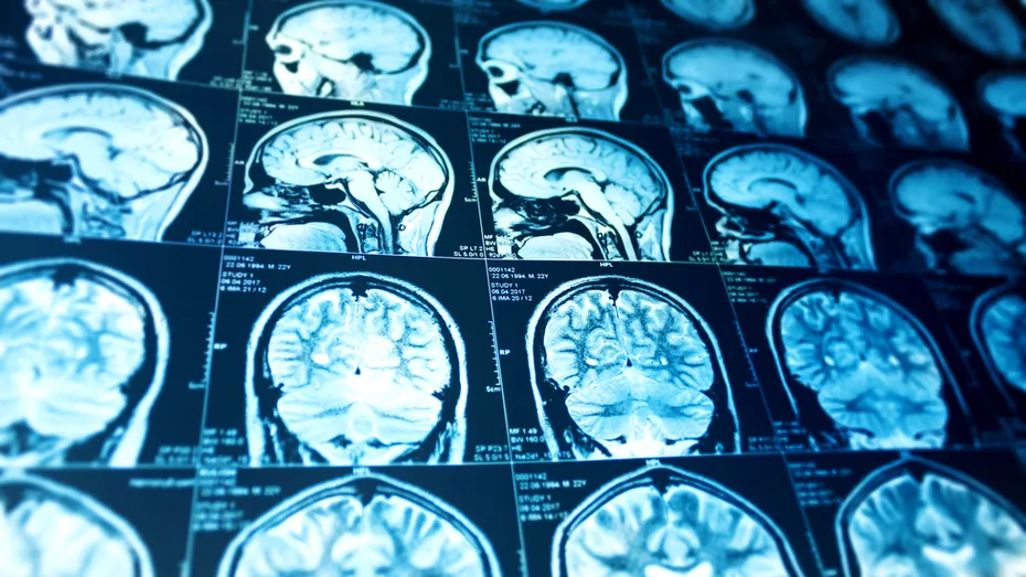 Ce influență are grupa de sânge asupra riscului de AVC la persoanele sub 60 de ani